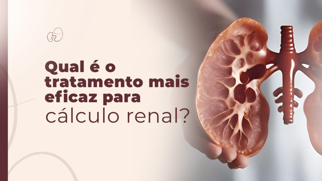 Qual é o tratamento mais eficaz para cálculo renal?