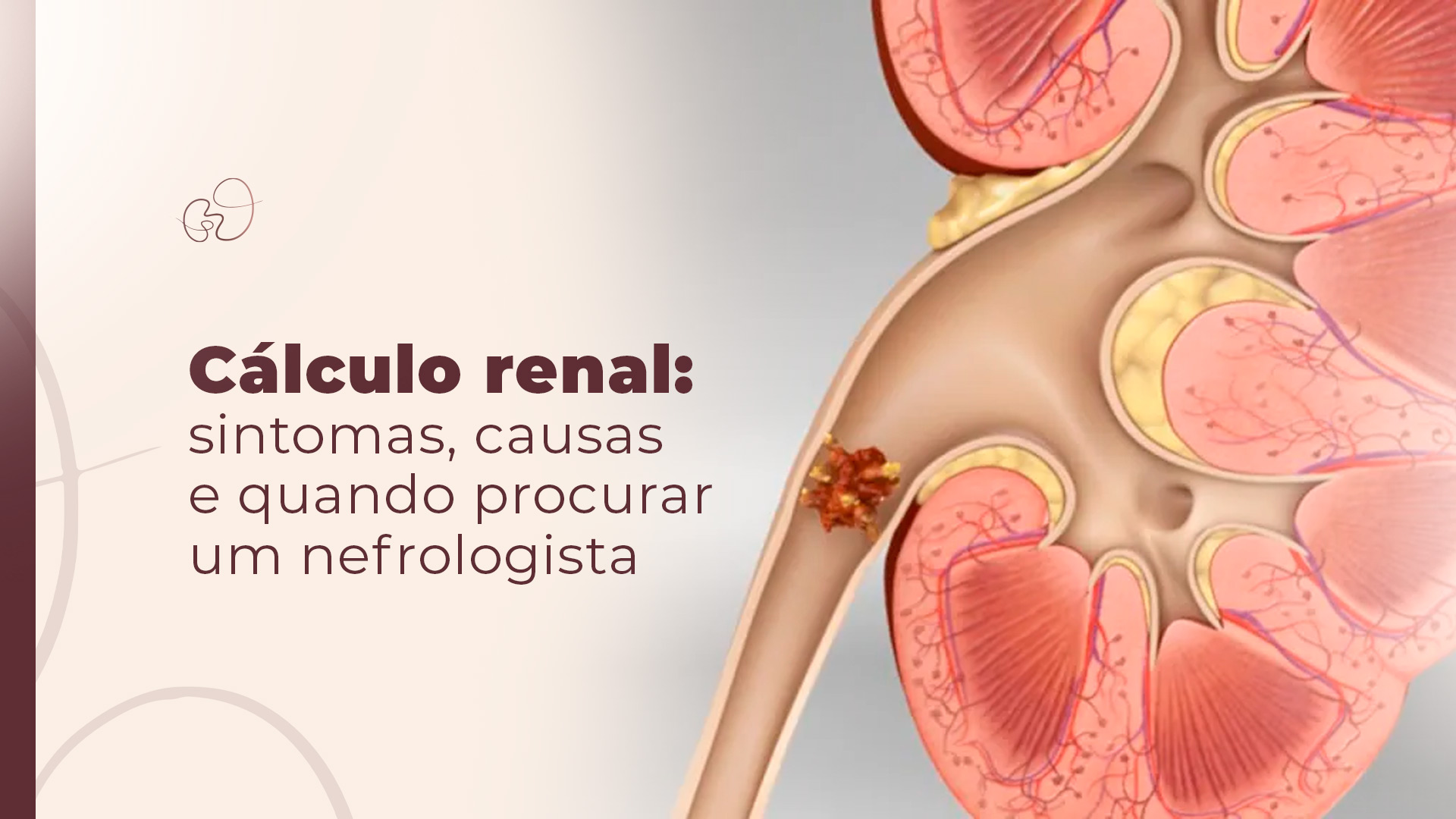Cálculo renal: quando procurar um nefrologista em São Paulo?